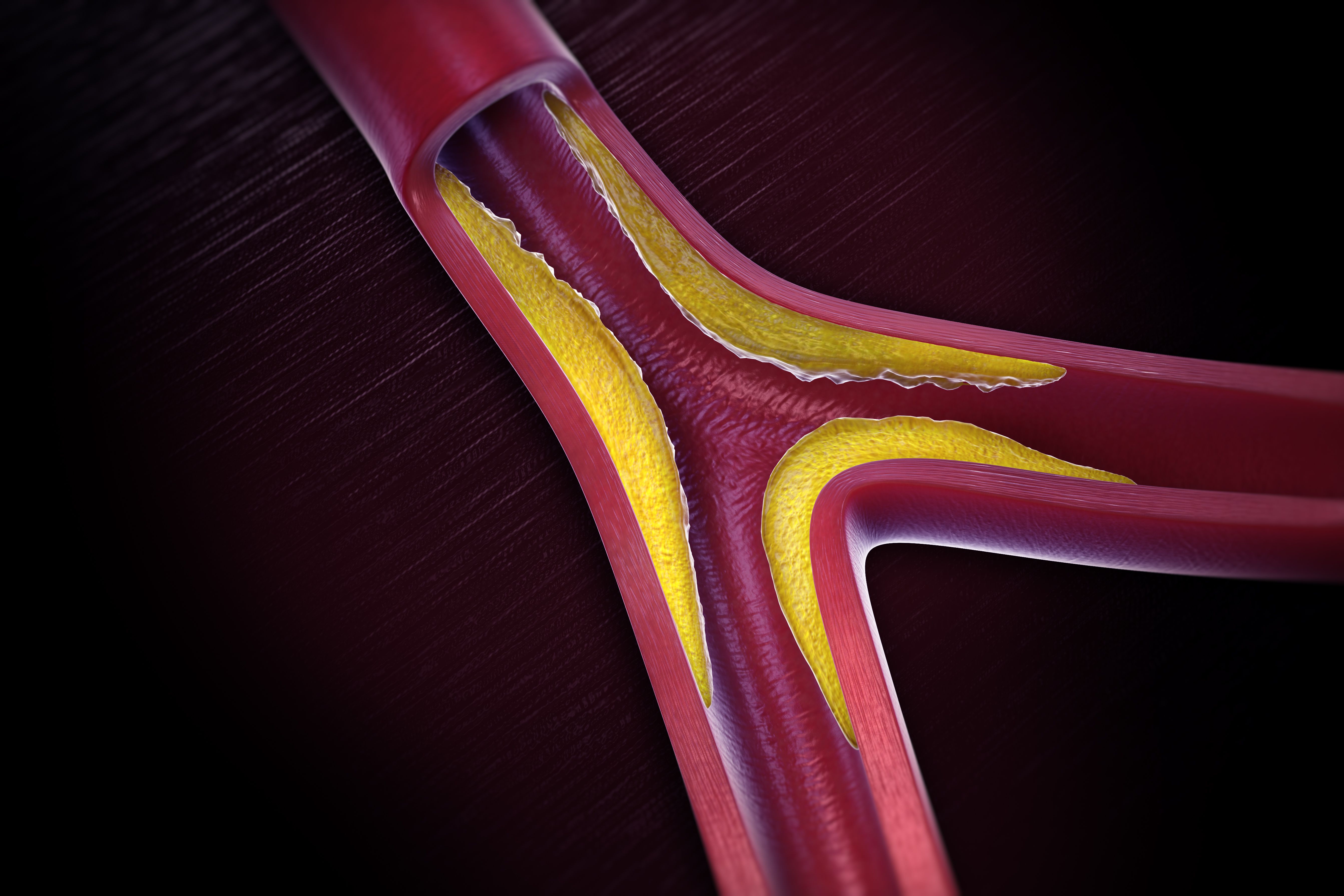 What you have to know about Peripheral Artery Disease?