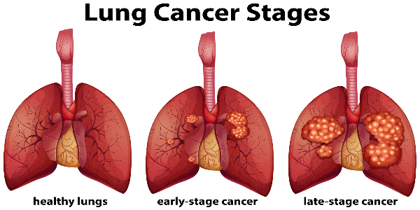 Lung cancer treatment in India