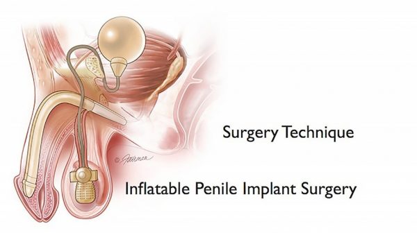 Penile Implant Surgery Treatments in India