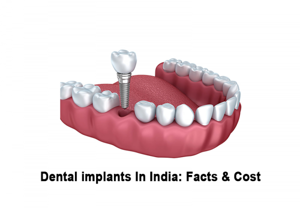 Low-cost dental implants are available in India