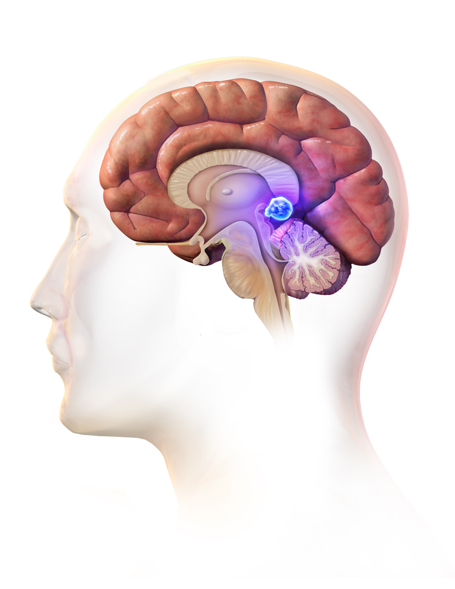 Brain Tumor Symptoms, Causes, and Treatment