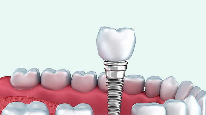 Immediate Loading Implants India