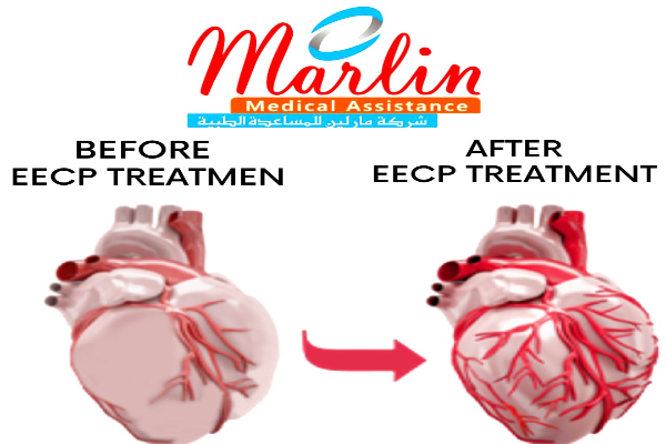 EECP (Enhanced external counter-pulsation)