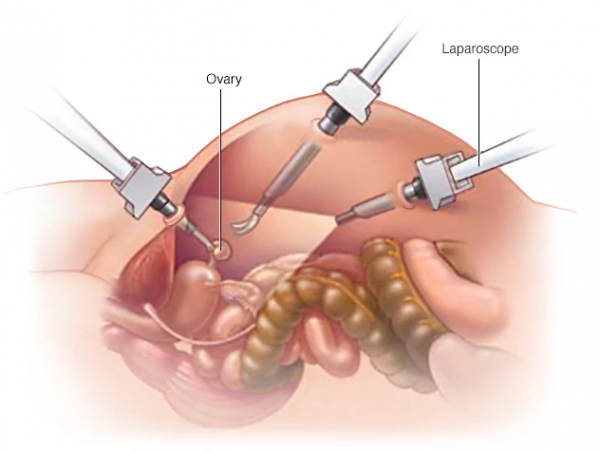 Hysterectomy Surgery