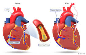 CABG (Coronary Artery Bypass Grafting)