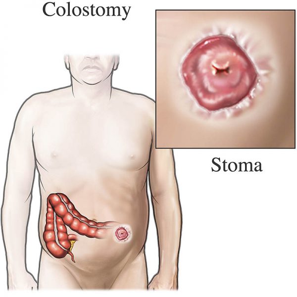 Colostomy Treatment in India