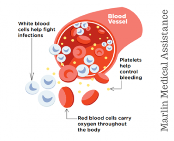 Bone Marrow Transplant (Stem cell transplant): Leukemia