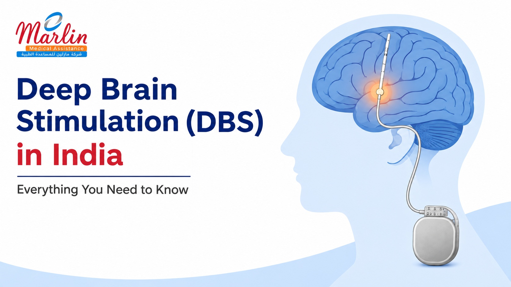 Deep Brain Stimulation (DBS) in India Everything You Need to Know Deep Brain Stimulation (DBS) in India Everything You Need to Know