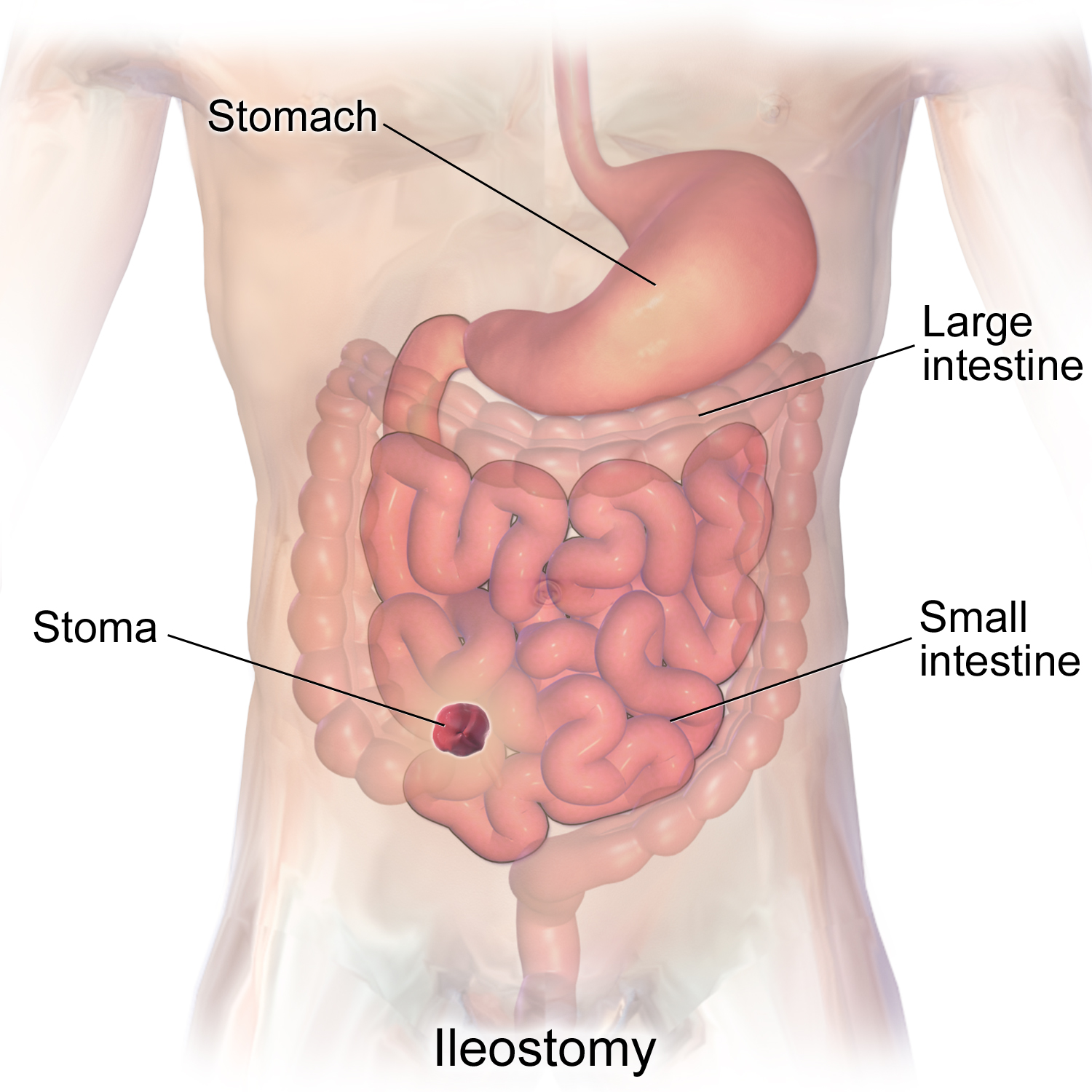 Ileostomy Surgery