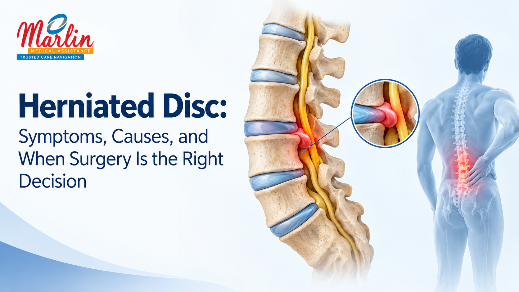 Herniated Disc: Symptoms, Causes and When Surgery is the Right Choice