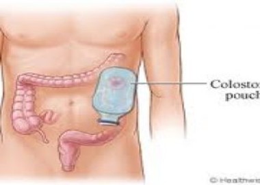 Colostomy