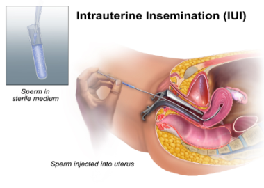 Intrauterine Insemination (IUI)
