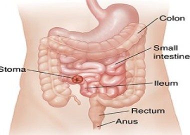 Ileostomy