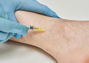 Sclerotherapy