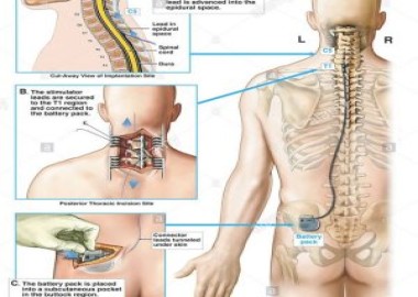 Spinal Cord Stimulator