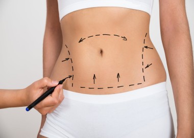 Tummy Tuck Surgery